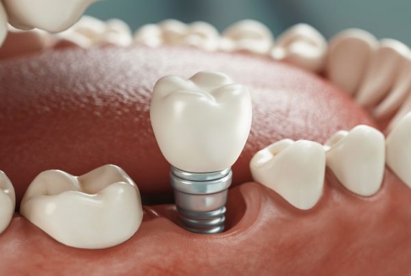 implantes-dentales