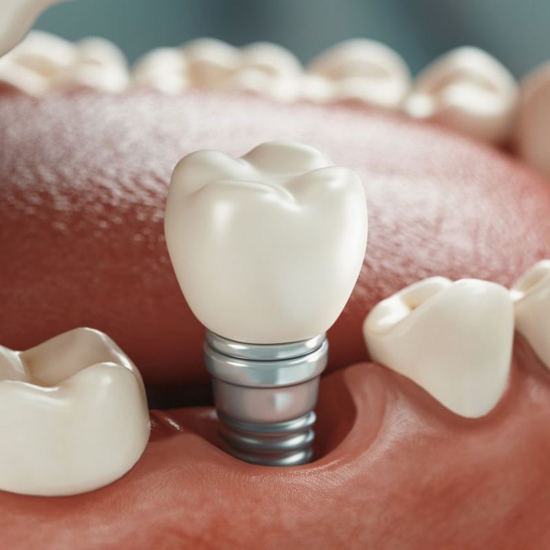implantes-dentales