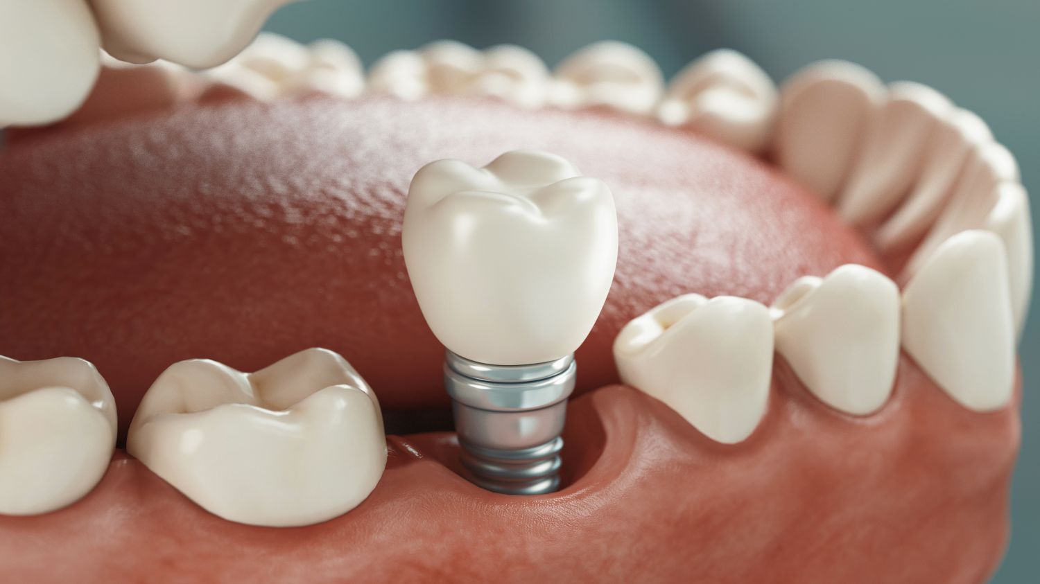 implantes-dentales